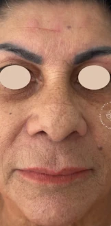 Antes: rosto de frente antes do tratamento com CO₂, com os olhos cobertos