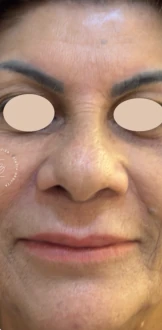 Depois: rosto de frente depois do tratamento com CO₂, com os olhos cobertos