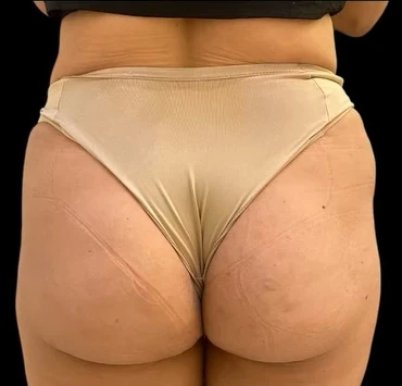 Antes: glúteos em vista posterior, antes do tratamento