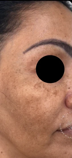 Antes: pele do rosto de perfil com manchas, com o olho coberto