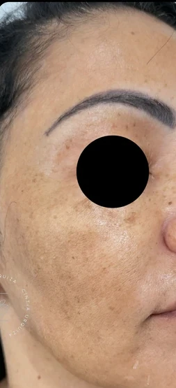 Depois: pele do rosto de perfil, com o olho coberto