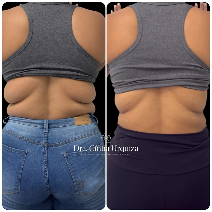 Publicação com duas fotos das costas em vista posterior, lado a lado, com a assinatura Dra. Cíntia Urquiza