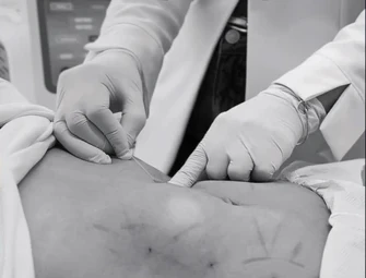 Mãos com luvas durante procedimento de Endolaser, em preto e branco
