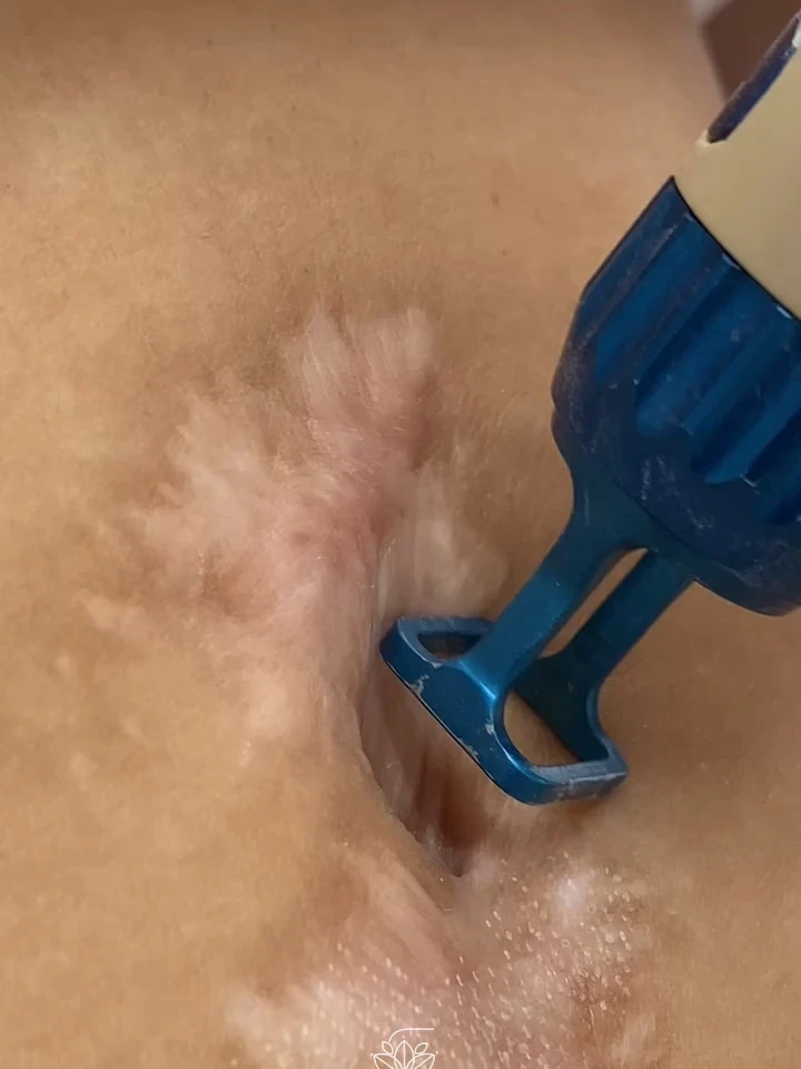 Close da pele durante procedimento com ponteira de equipamento